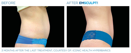 Emsculpt NEO Before and After Tummy Side